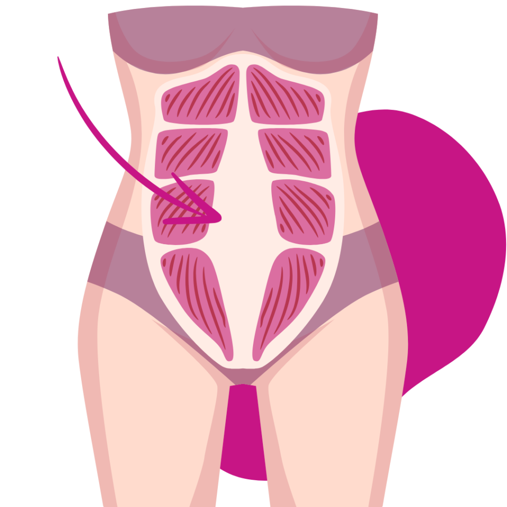 Grafik die, die geraden Bauchmuskeln mit einem Spalt abbildet, der sogenannten Rektusdiastase